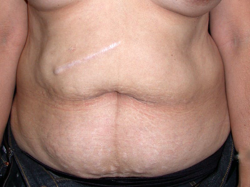 Abdominoplasty Before & After Gallery - Patient 188562 - Image 1