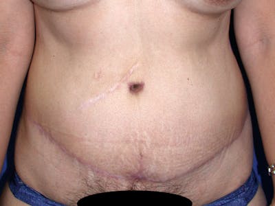 Abdominoplasty Before & After Gallery - Patient 188562 - Image 2