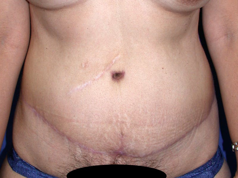 Abdominoplasty Before & After Gallery - Patient 188562 - Image 2
