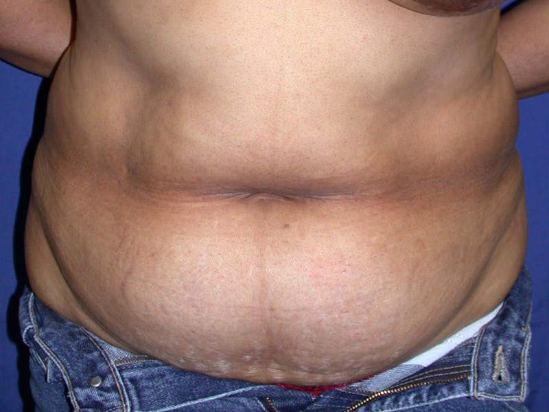 Abdominoplasty Before & After Gallery - Patient 404711 - Image 1