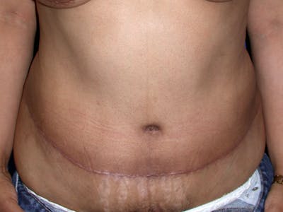 Abdominoplasty Before & After Gallery - Patient 404711 - Image 2