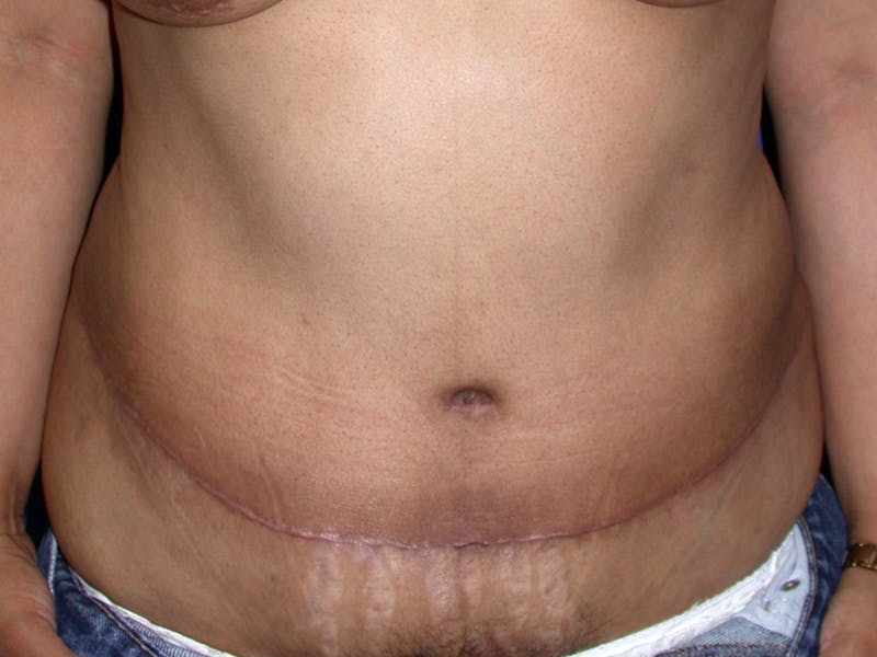 Abdominoplasty Before & After Gallery - Patient 404711 - Image 2