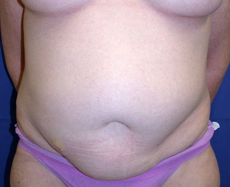 Abdominoplasty Before & After Gallery - Patient 419642 - Image 1