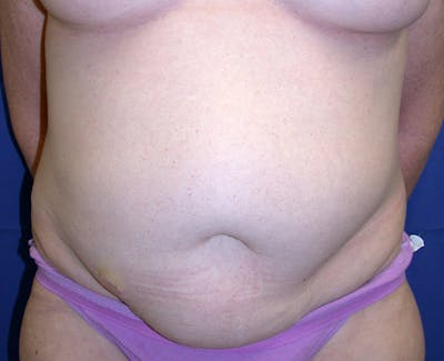 Abdominoplasty Before & After Gallery - Patient 419642 - Image 1