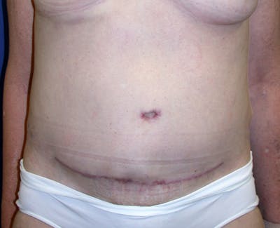 Abdominoplasty Before & After Gallery - Patient 419642 - Image 2