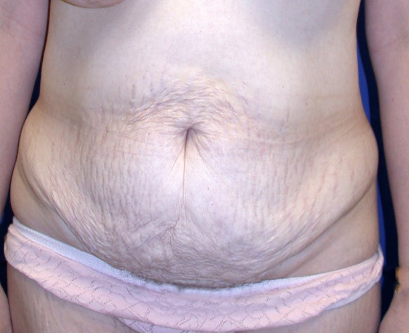 Abdominoplasty Before & After Gallery - Patient 520122 - Image 1