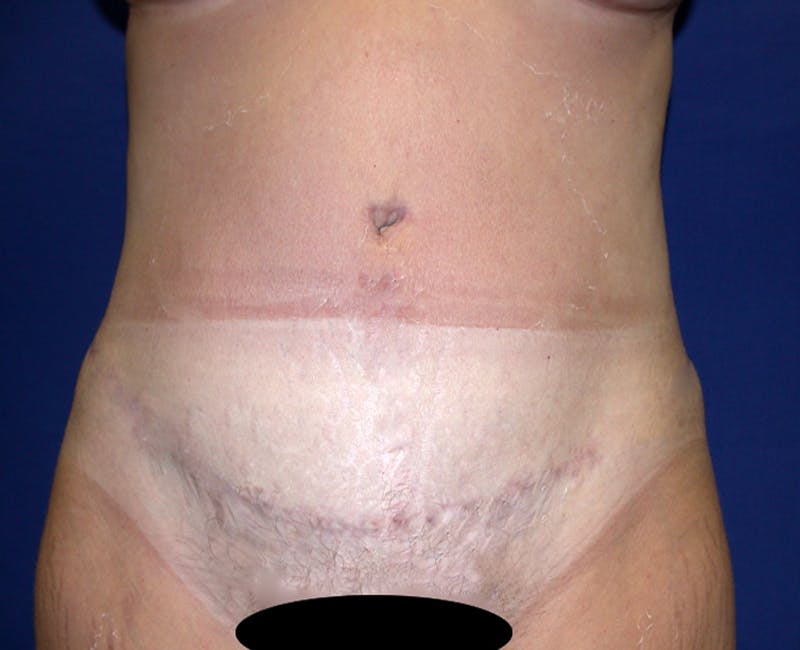 Abdominoplasty Before & After Gallery - Patient 520122 - Image 2