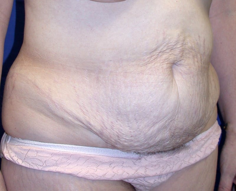 Abdominoplasty Before & After Gallery - Patient 520122 - Image 3