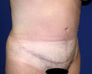 Abdominoplasty Before & After Gallery - Patient 520122 - Image 4