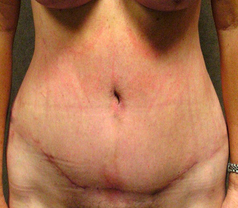 Abdominoplasty Before & After Gallery - Patient 397339 - Image 2