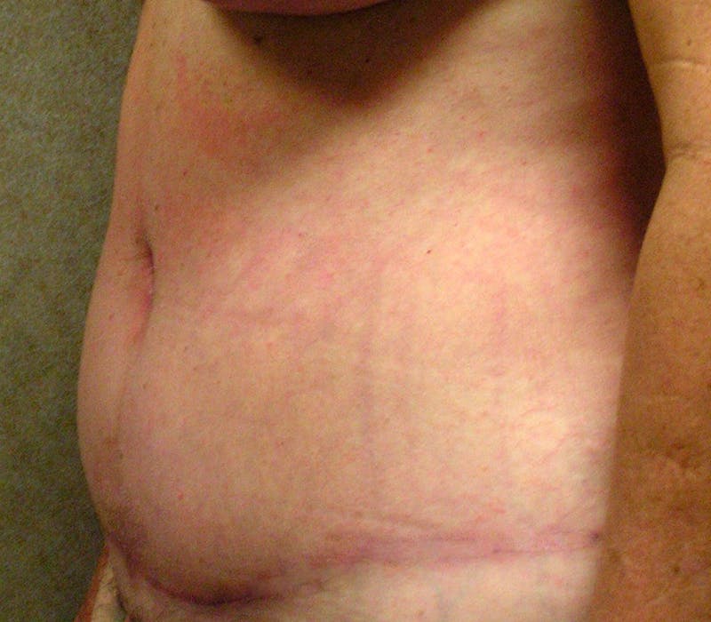 Abdominoplasty Before & After Gallery - Patient 397339 - Image 4