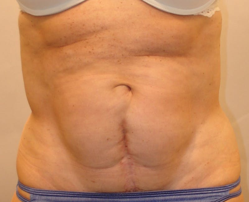 Abdominoplasty Before & After Gallery - Patient 321753 - Image 1