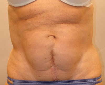 Abdominoplasty Before & After Gallery - Patient 321753 - Image 1