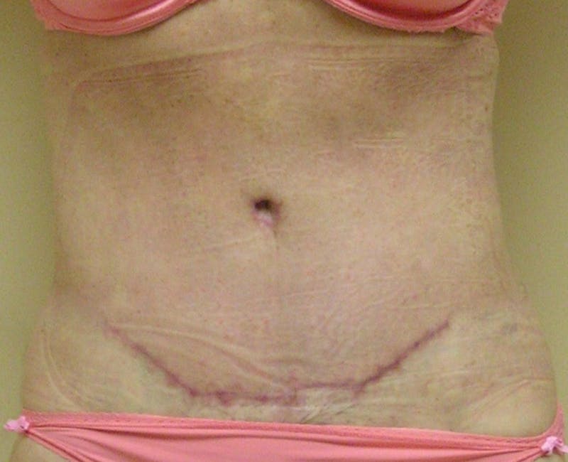 Abdominoplasty Before & After Gallery - Patient 321753 - Image 2