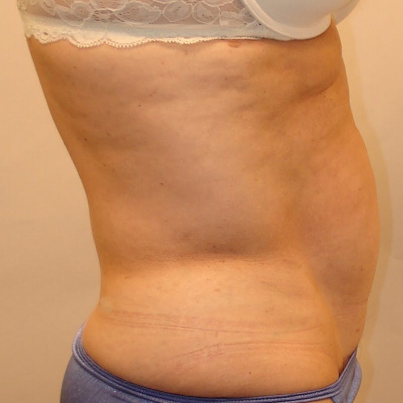 Abdominoplasty Before & After Gallery - Patient 321753 - Image 3