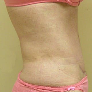 Abdominoplasty Before & After Gallery - Patient 321753 - Image 4