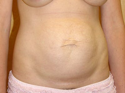 Abdominoplasty Before & After Gallery - Patient 151062 - Image 1