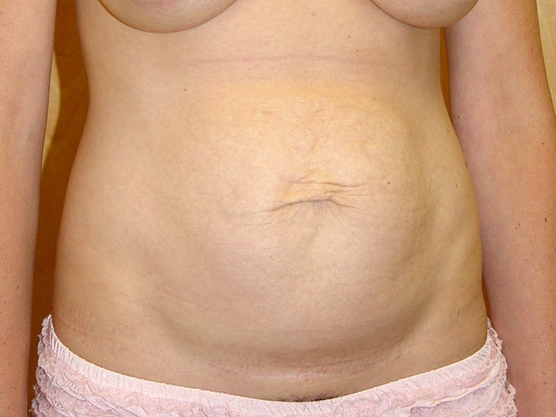 Abdominoplasty Before & After Gallery - Patient 151062 - Image 1