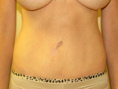 Abdominoplasty Before & After Gallery - Patient 151062 - Image 2
