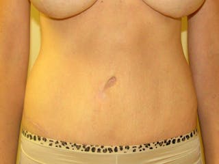 Abdominoplasty Before & After Gallery - Patient 151062 - Image 2