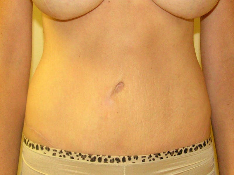 Abdominoplasty Before & After Gallery - Patient 151062 - Image 2