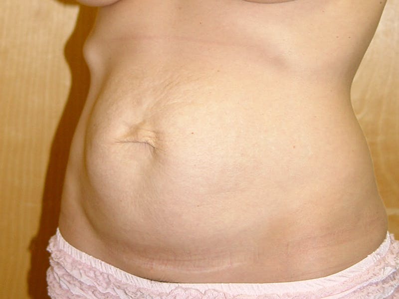 Abdominoplasty Before & After Gallery - Patient 151062 - Image 3