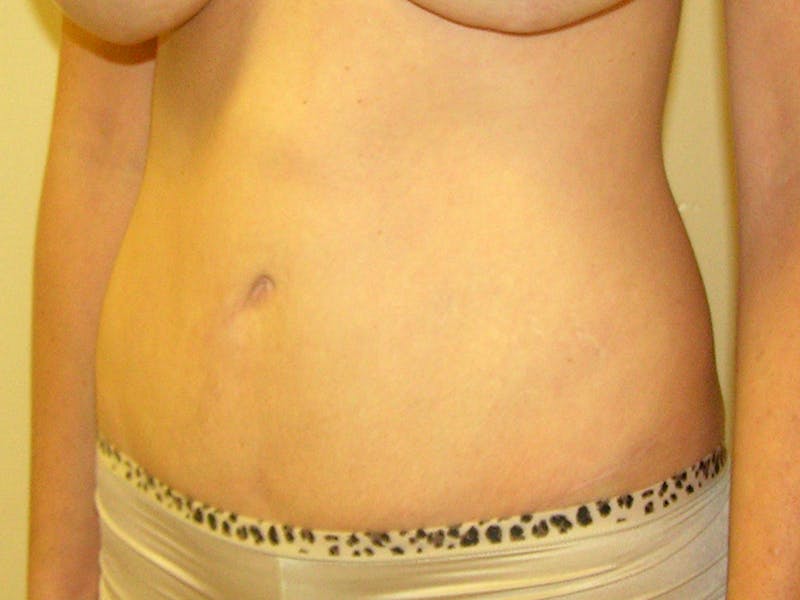 Abdominoplasty Before & After Gallery - Patient 151062 - Image 4