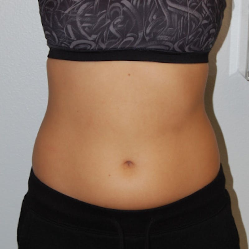 Liposuction Before & After Gallery - Patient 170695 - Image 1
