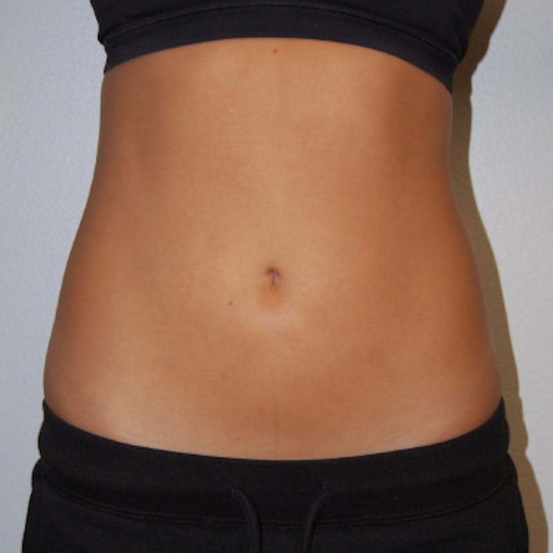 Liposuction Before & After Gallery - Patient 170695 - Image 2