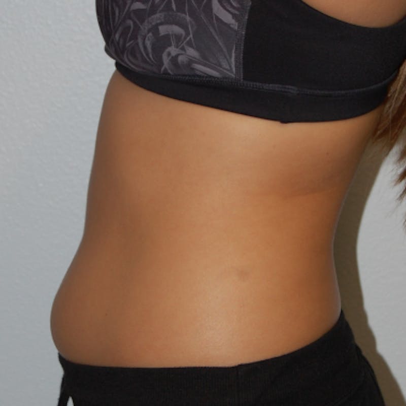 Liposuction Before & After Gallery - Patient 170695 - Image 3
