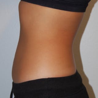 Liposuction Before & After Gallery - Patient 170695 - Image 4
