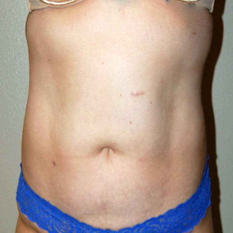 Liposuction Before & After Gallery - Patient 959416 - Image 2