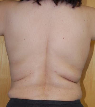 Liposuction Before & After Gallery - Patient 245003 - Image 1