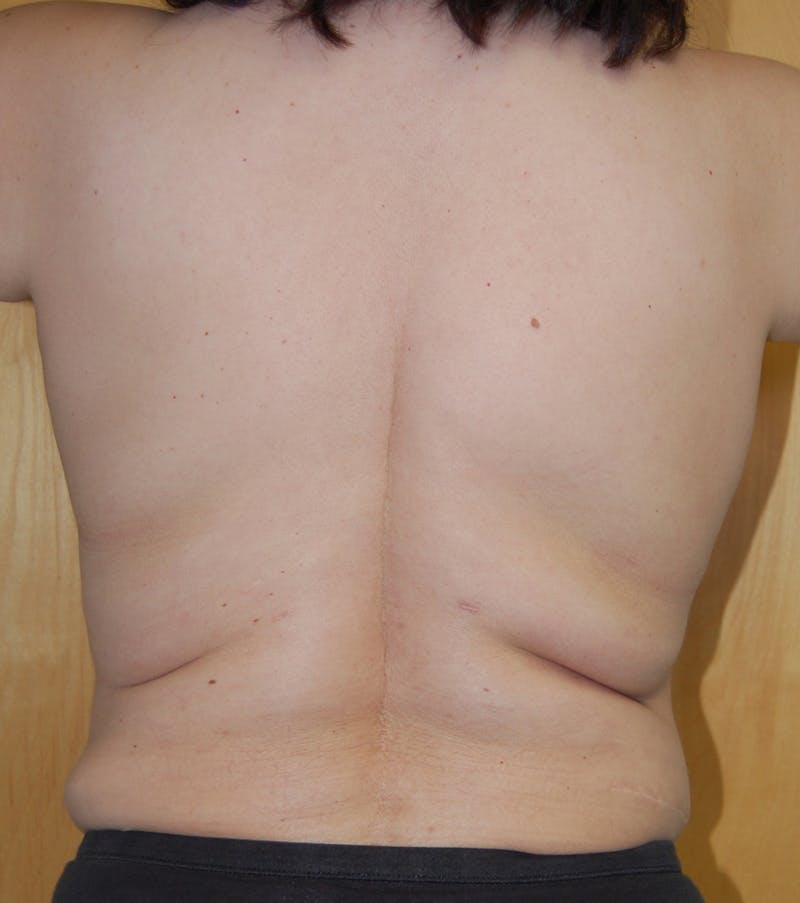 Liposuction Before & After Gallery - Patient 245003 - Image 1
