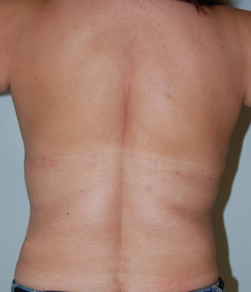 Liposuction Before & After Gallery - Patient 245003 - Image 2
