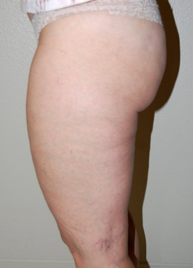 Liposuction Before & After Gallery - Patient 451196 - Image 3