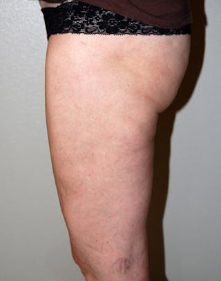 Liposuction Before & After Gallery - Patient 451196 - Image 4