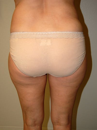 Liposuction Before & After Gallery - Patient 323636 - Image 1
