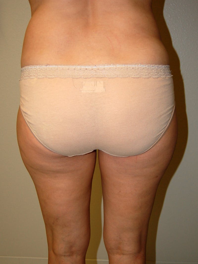 Liposuction Before & After Gallery - Patient 323636 - Image 1