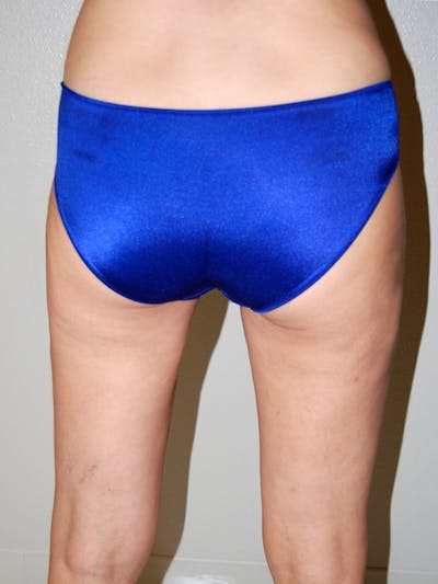 Liposuction Before & After Gallery - Patient 323636 - Image 2
