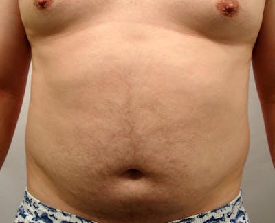 Liposuction Before & After Gallery - Patient 353784 - Image 1
