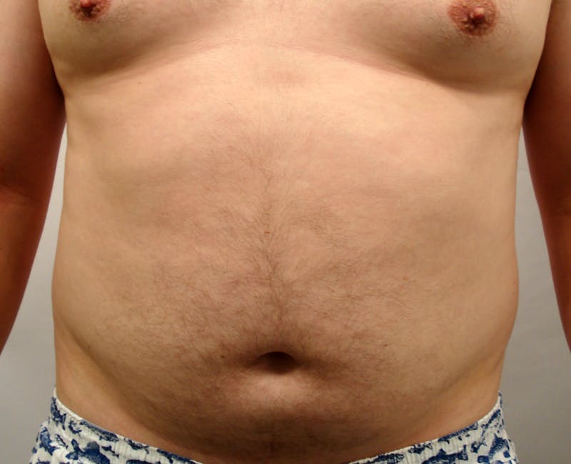 Liposuction Before & After Gallery - Patient 353784 - Image 1