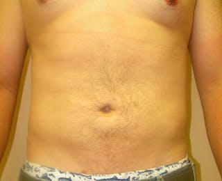 Liposuction Before & After Gallery - Patient 353784 - Image 2