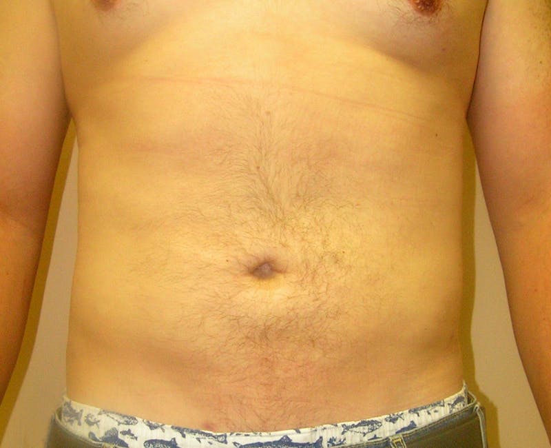 Liposuction Before & After Gallery - Patient 353784 - Image 2