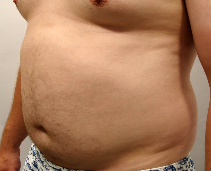 Liposuction Before & After Gallery - Patient 353784 - Image 3
