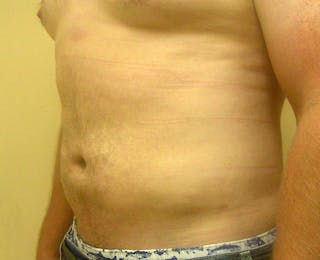 Liposuction Before & After Gallery - Patient 353784 - Image 4