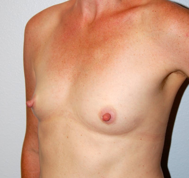 Breast Augmentation Before & After Gallery - Patient 104698 - Image 3