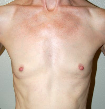 Breast Augmentation Before & After Gallery - Patient 309437 - Image 1