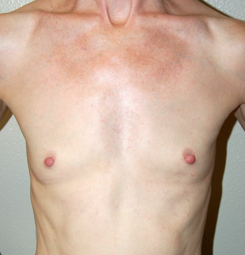 Breast Augmentation Before & After Gallery - Patient 309437 - Image 1