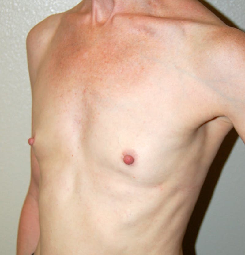 Breast Augmentation Before & After Gallery - Patient 309437 - Image 3